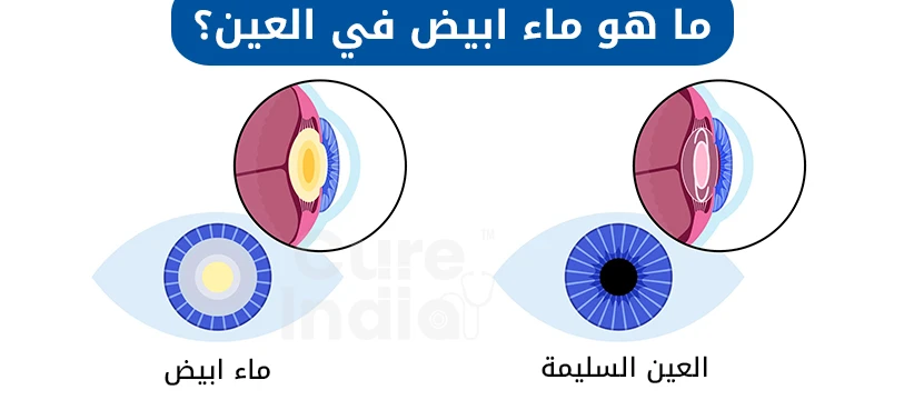 ما هو إعتام عدسة العين؟